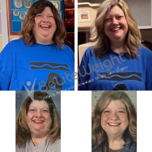 RNY Gastric Bypass Before and After Weight Loss Surgery Before and After